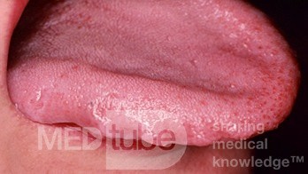Crenellated Tongue