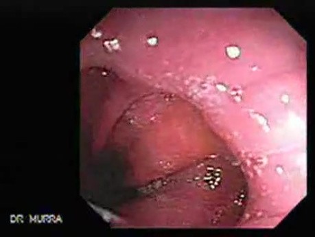 Barrett's Esophagus of long segment (16 of 24)