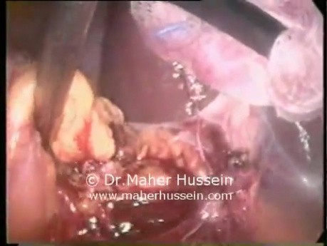 Right donor nephrectomy - Laparoscopic Approach
