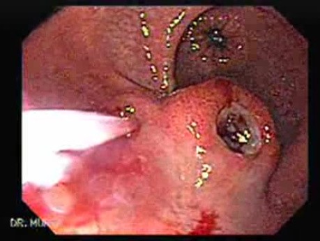 Gastrointestinal Stromal Tumor - GIST (6 of 65)