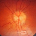 Endoscopic Third Ventriculostomy in a Benign Case of Aicardi Syndrome with Obstructive Hydrocephalus and Chiari Malformation type 1