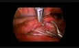 Thoracoscopic Repair of Esophageal Atresia