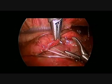 esophageal atresia repair
