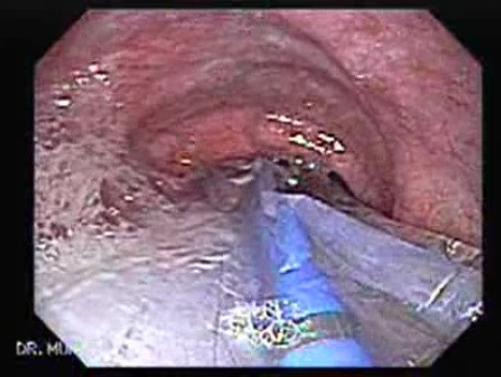 Esophagus - Pneumatic Dilation for Achalasia - Beginning of the Procedure