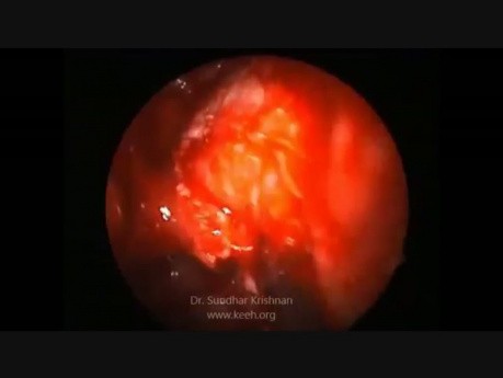 Recurrent Fungal Sinusitis with Orbital Extension