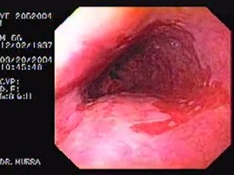 Barrett's Esophagus of long segment (1 of 24)