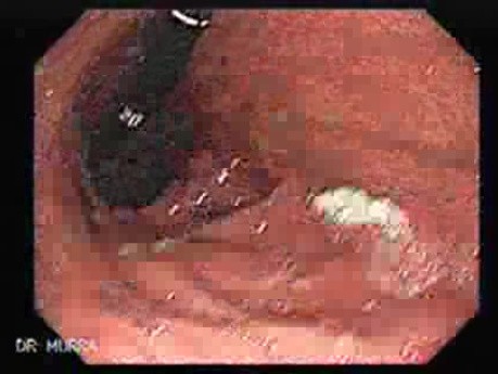 Fibrosis as a Cause of Hourglass Stomach 