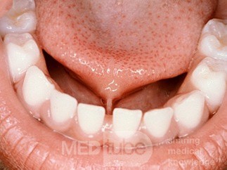 Tongue Tie