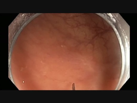 Colonoscopy - Transverse Colon Subtle Lesion