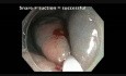 Colonoscopy Channel - EMR Of Subtle Flat Lesion