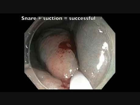 Colonoscopy Channel - EMR Of Subtle Flat Lesion