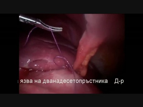 Laparoscopic Operation for Perforated Peptic Ulcer