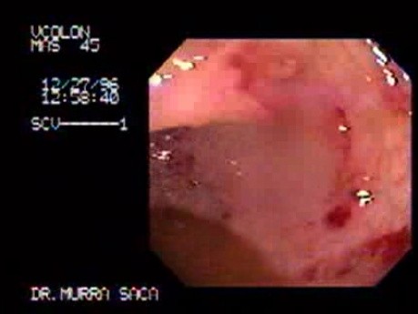 Amebic Colitis 3