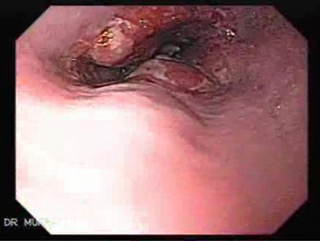 Barrett Adenocarcinoma - Therapeutic Endoscopy (2 of 7)