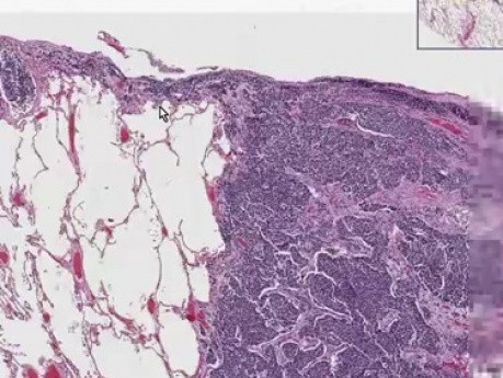 Metastatic small cell carcinoma - Histopathology - Lung, subpleural