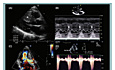 Echocardiography in Hypertrophic Cardiomyopathy