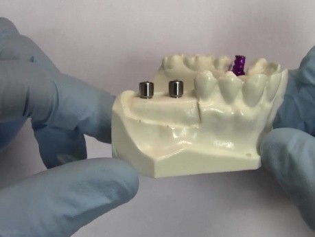 Dental Implant Staging Model - Model Demonstration