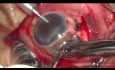 A Neglected Open Globe Injury Managed Using Scleral Tuck Lens to Salvage Vision
