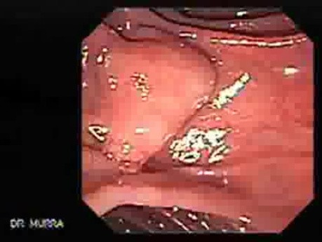 Larynx with Jaundice (5 of 6)