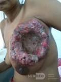 Fingering Left Breast Tumor