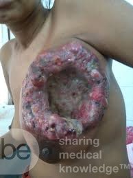 Fingering Left Breast Tumor