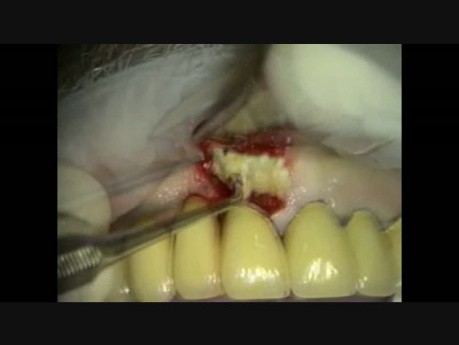 Socket Preservation #8 Failing Bridge Abutment