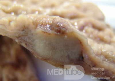 Adenocarcinoma of the Antrum and incisura angularis (9 of 12)