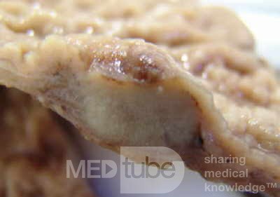 Adenocarcinoma of the Antrum and incisura angularis (9 of 12)