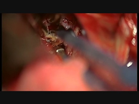 Left VA/PICA Aneurysm Microsurgical Clipping
