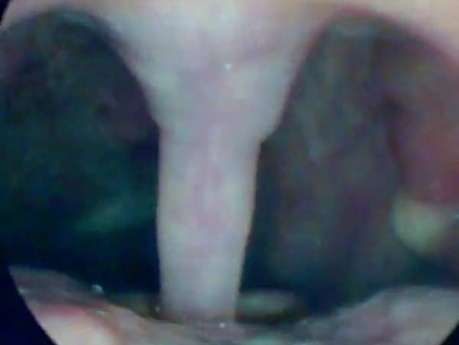 An Elongation of Uvula