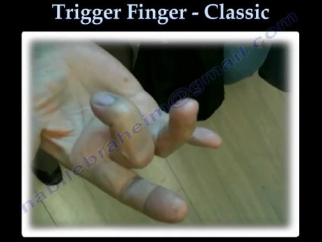 Classic Trigger Finger - Case
