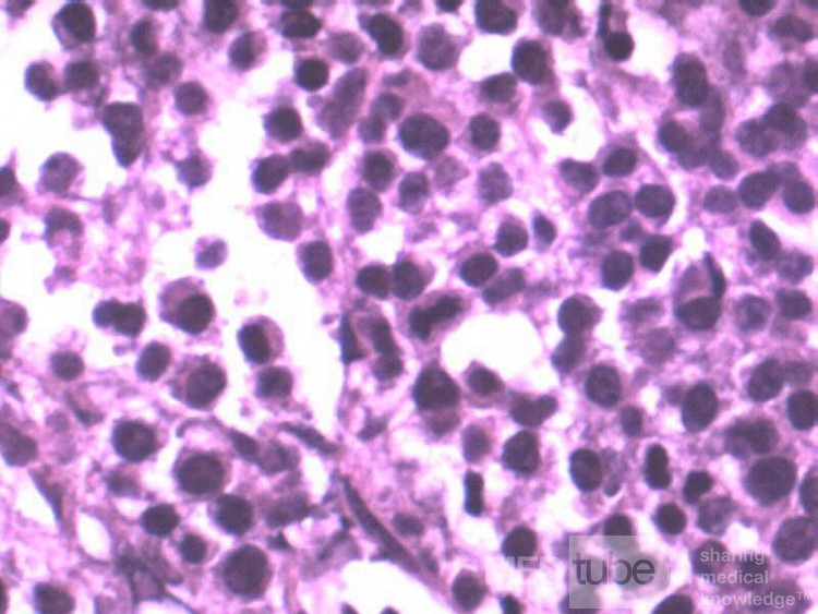 Colon Angiodysplasia and Multiple Myeloma (24 of 24)