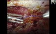 Webinar: Quill Barbed Suture in Robotic Hernia Surgery