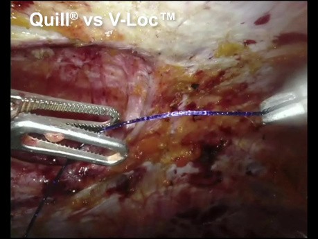 Webinar: Quill Barbed Suture in Robotic Hernia Surgery 