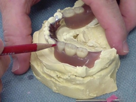 Denture Wrought Wire Clasp Repair - Discussion With Professor Bates