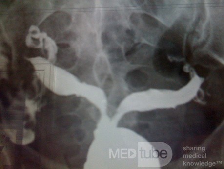 HSG Septate Uterus