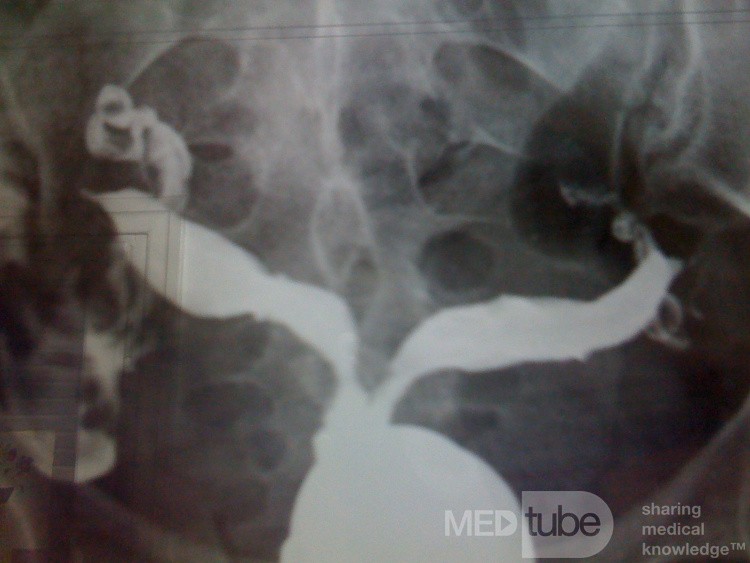 HSG Septate Uterus