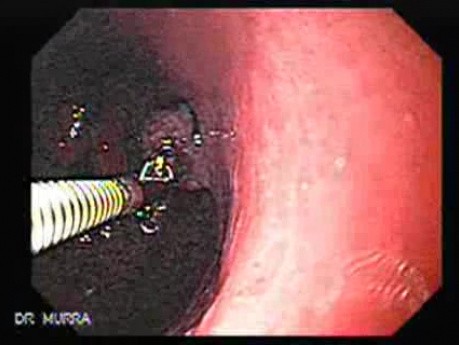 Hyperplastic Polyps - Endoscopy (4 of 14)