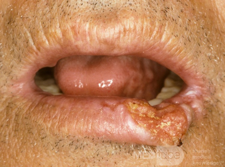 Squamous Cell Carcinoma of the Lower Lip