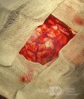 Decompressive Craniotomy