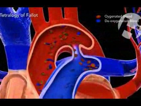 Ductus in Tetralogy of Fallot