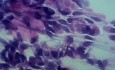 Urinary Incontinence in Women