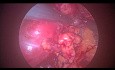 Retroperitoneal Laparoscopic Surgery to Remove Cystic Kidney Tumor