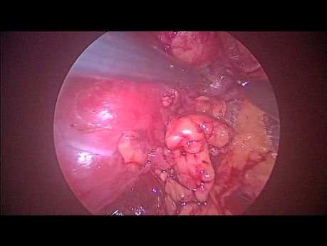 Retroperitoneal Laparoscopic Surgery to Remove Cystic Kidney Tumor
