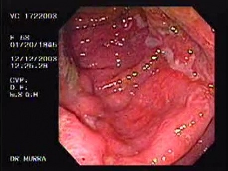 Unspecific Colitis due to Shigellosis (2 of 7)