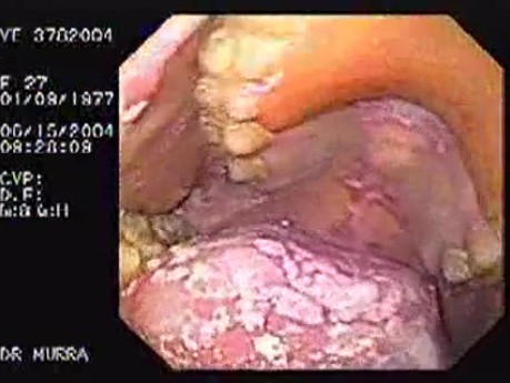 Oropharynge-Esophagic Candidiasis (2 of 5)