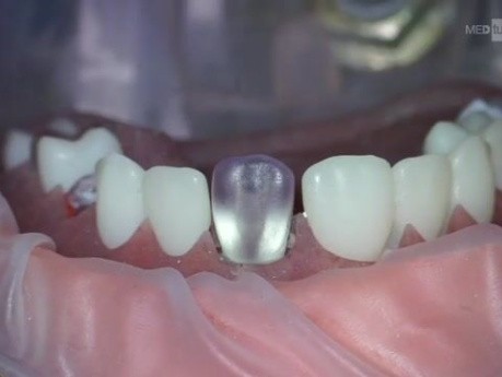 Piezo Surgery in Microscopic Endodontic Surgery