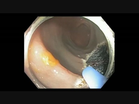 Colonoscopy - Transverse Colon - EMR