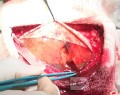 Acute Spontaneous Subdural Hemorrhage in the Subdural Space
