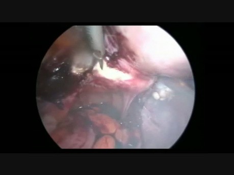 Laparoscopic Hysterectomy